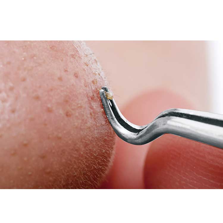 Pull Open Pore Tweezers – Precision Blackhead & Sebum Remover (Stainless Steel)