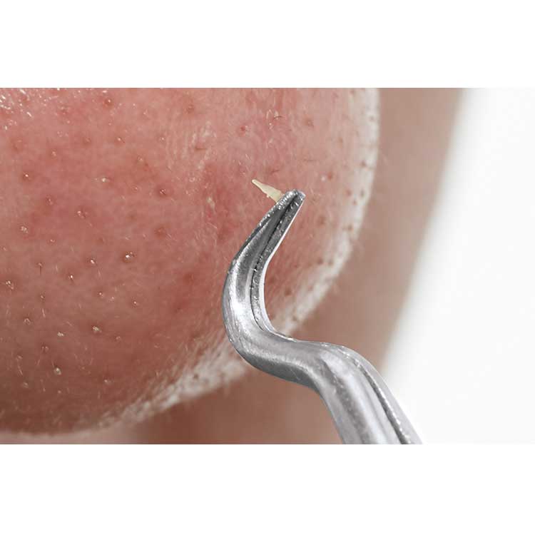 Pull Open Pore Tweezers – Precision Blackhead & Sebum Remover (Stainless Steel)